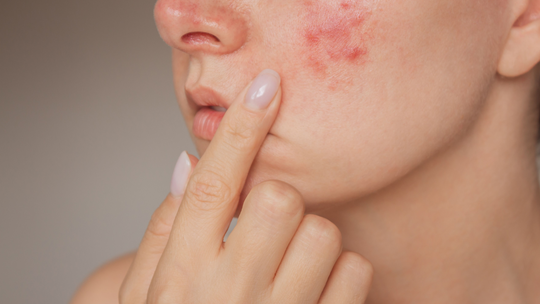 Wybierz profesjonalne kosmetyki na trądzik różowaty